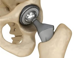medical titanium implant